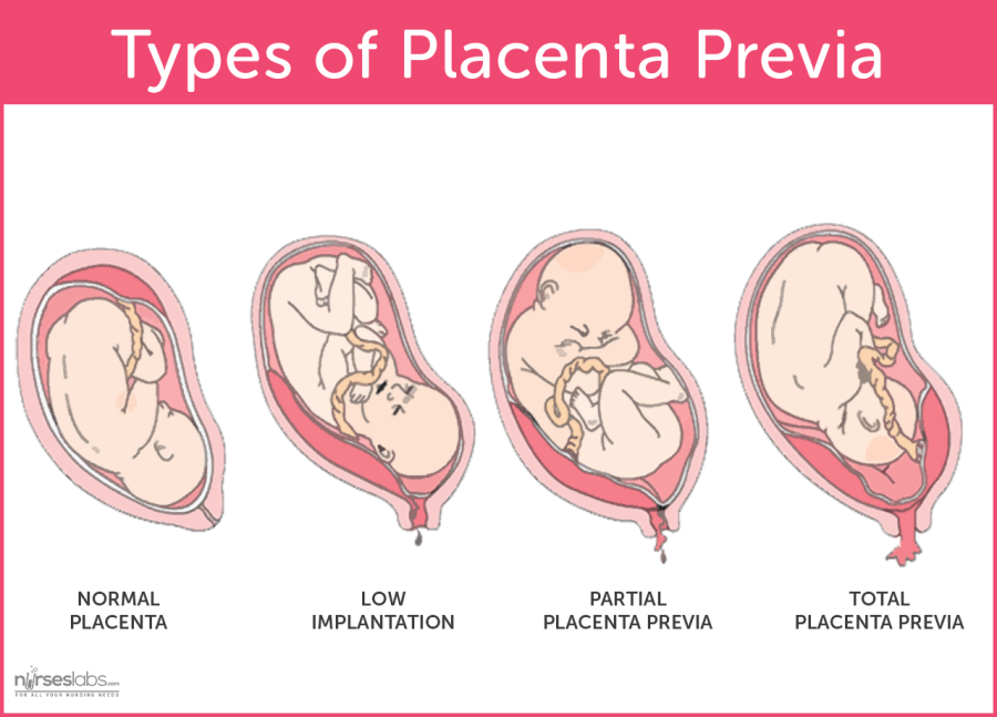 Which Maternal Risk Is Associated With Placenta Previa